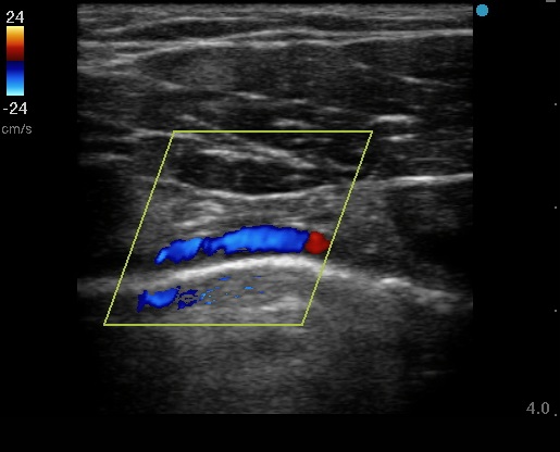 <p>Parasternal Doppler