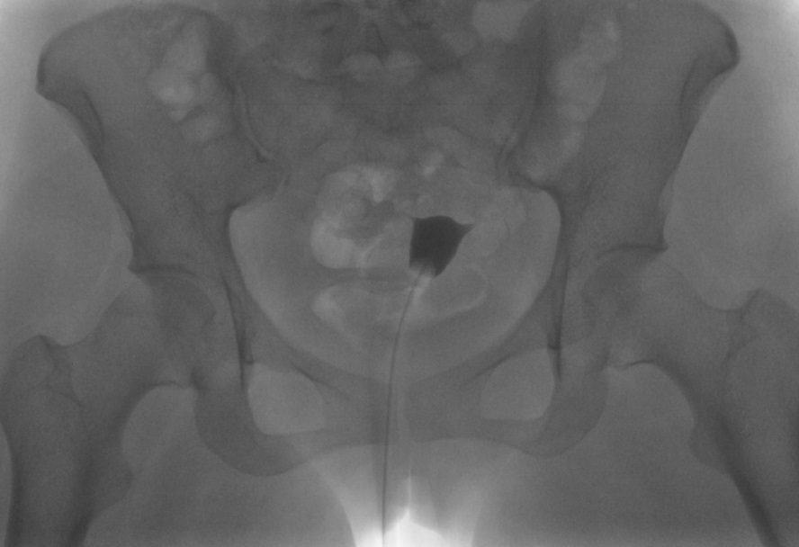 <p>Hysterosalpingogram Image Following Contrast Media Installation