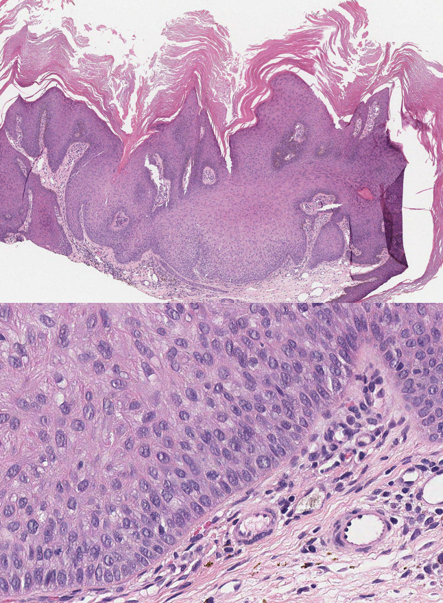 <p>Trichilemmoma Comparison View</p>