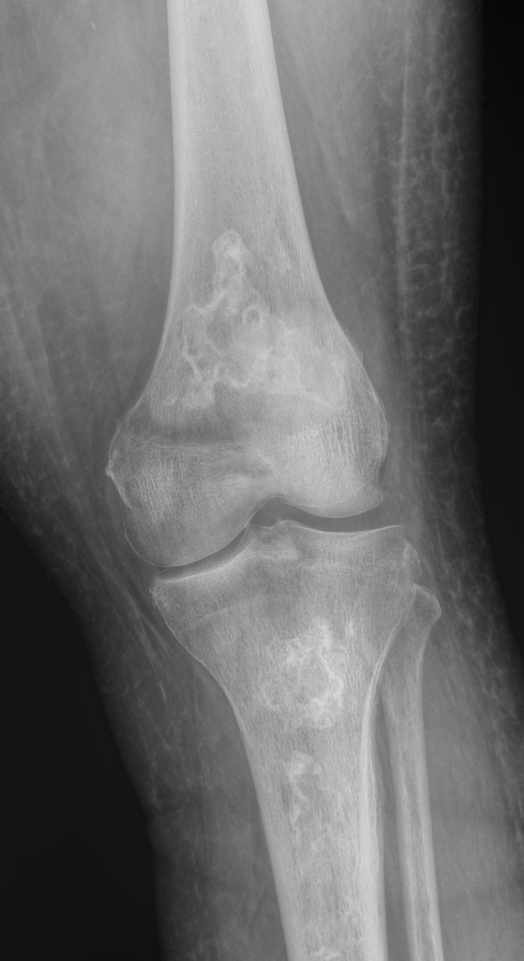 <p>Metaphyseal Osteonecrosis