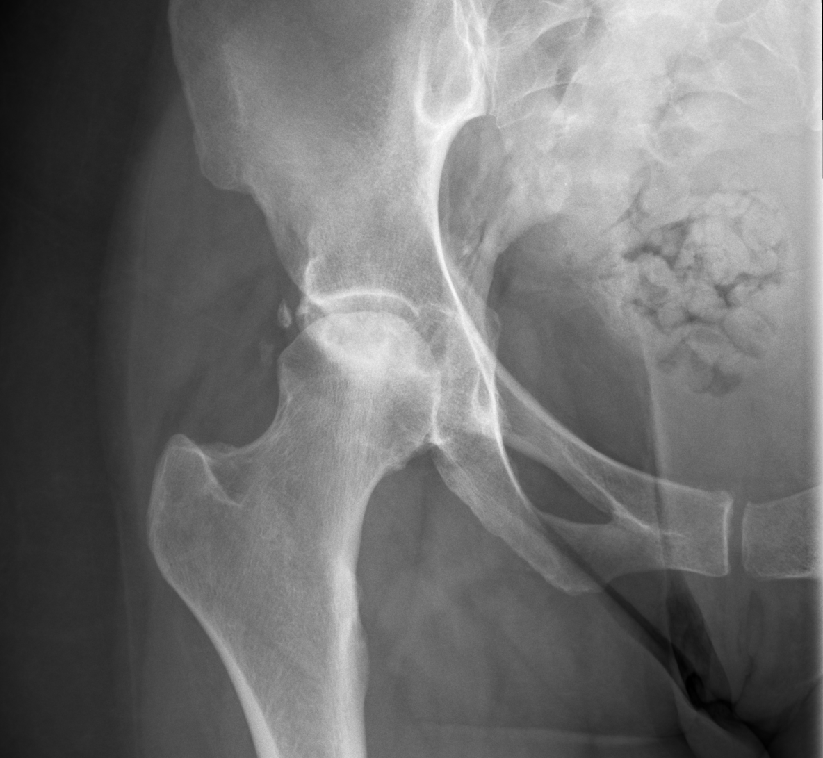 <p>Articular Collapse