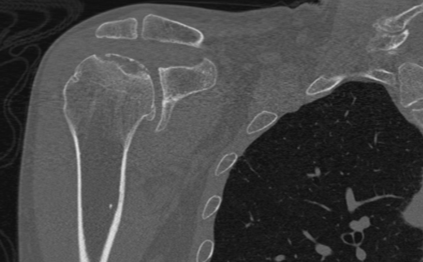 <p>Crescent Sign on CT scan