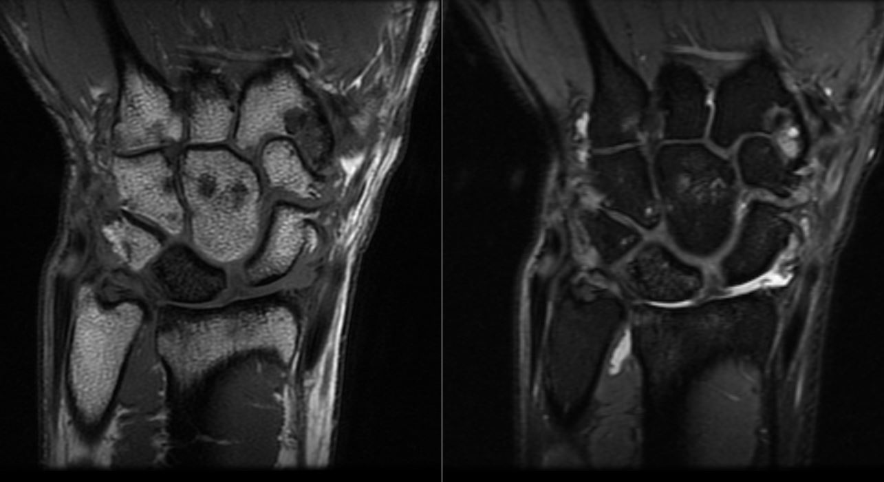 <p>MRI findings of Kienbock Disease