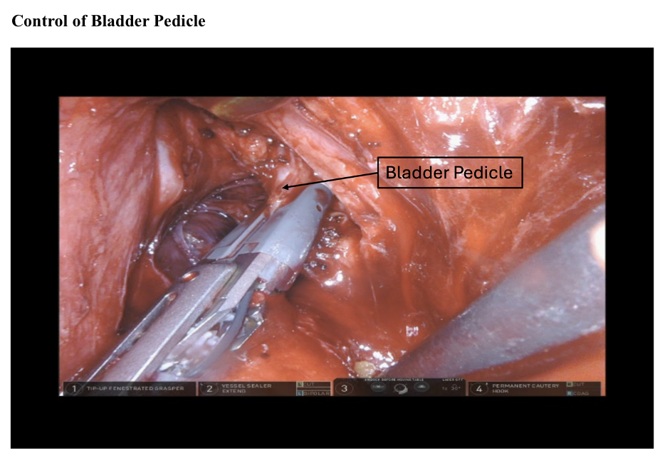 <p>Control of Bladder Pedicle</p>