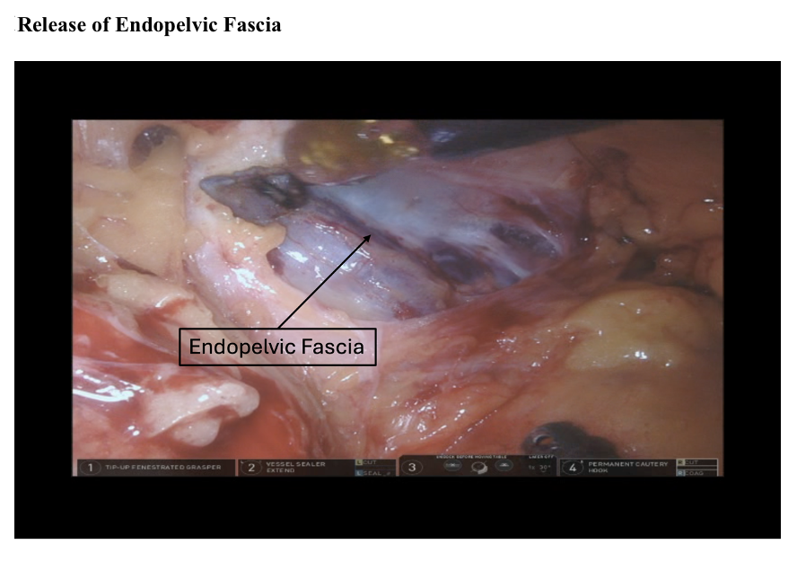 <p>Release of Endopelvic Fascia</p>