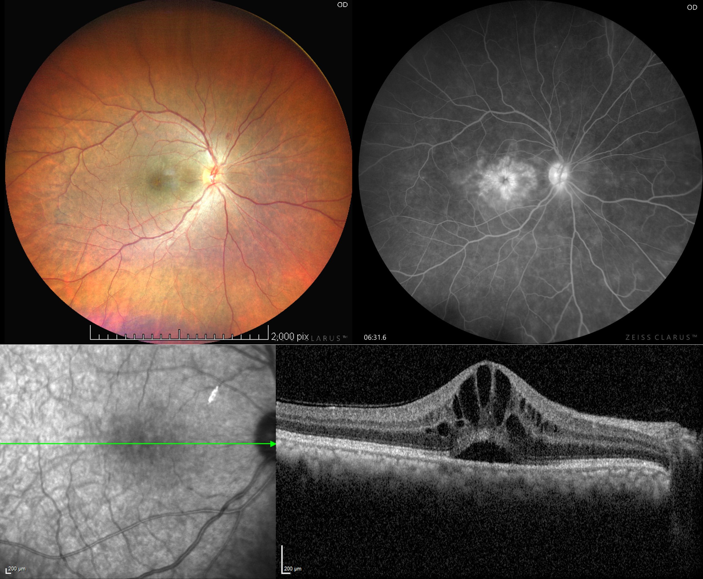 <p>Pseudophakic Cystoid Macular Edema