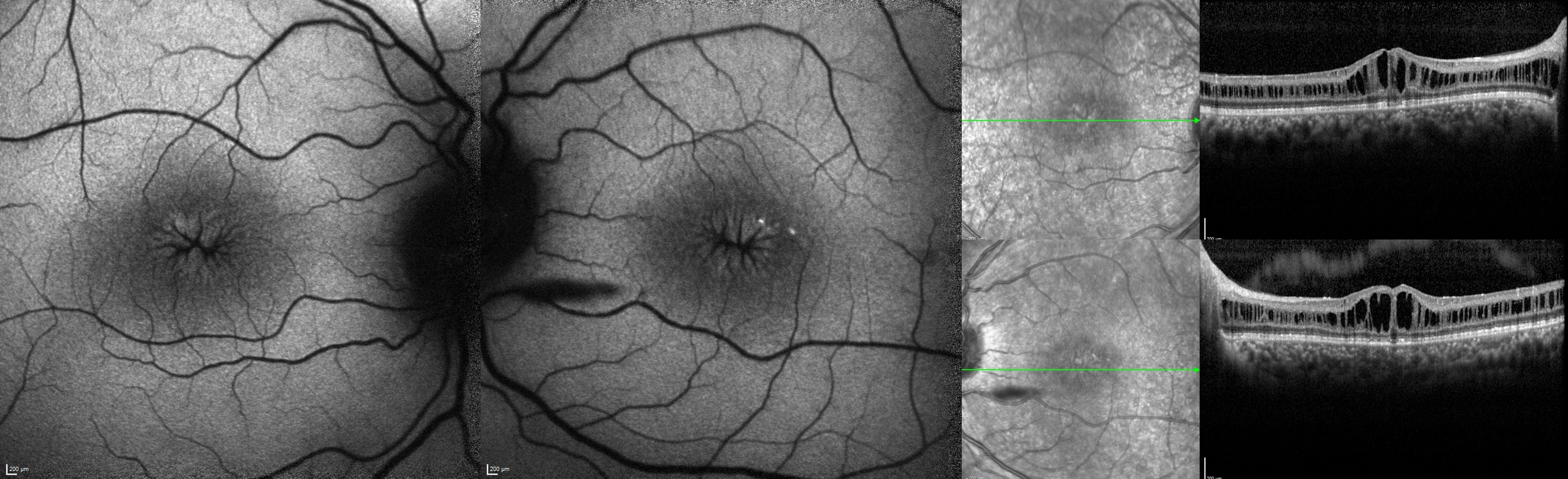 <p>Juvenile X-Linked Retinoschisis