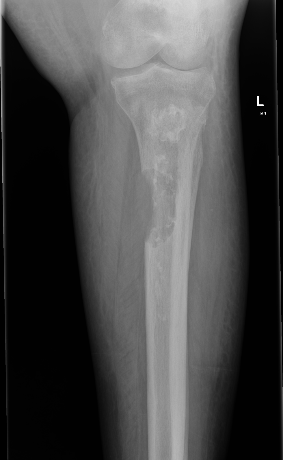 <p>Osteolytic Lesion