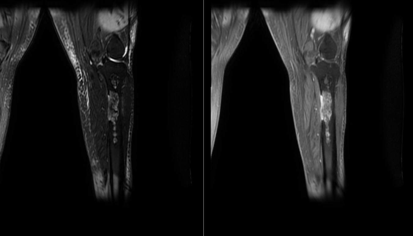 <p>MRI of Malignant Transformation