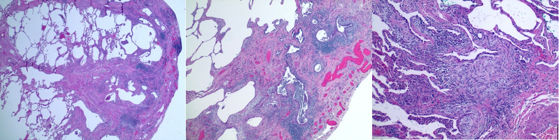 <p>Histopathology of UIP in IPF