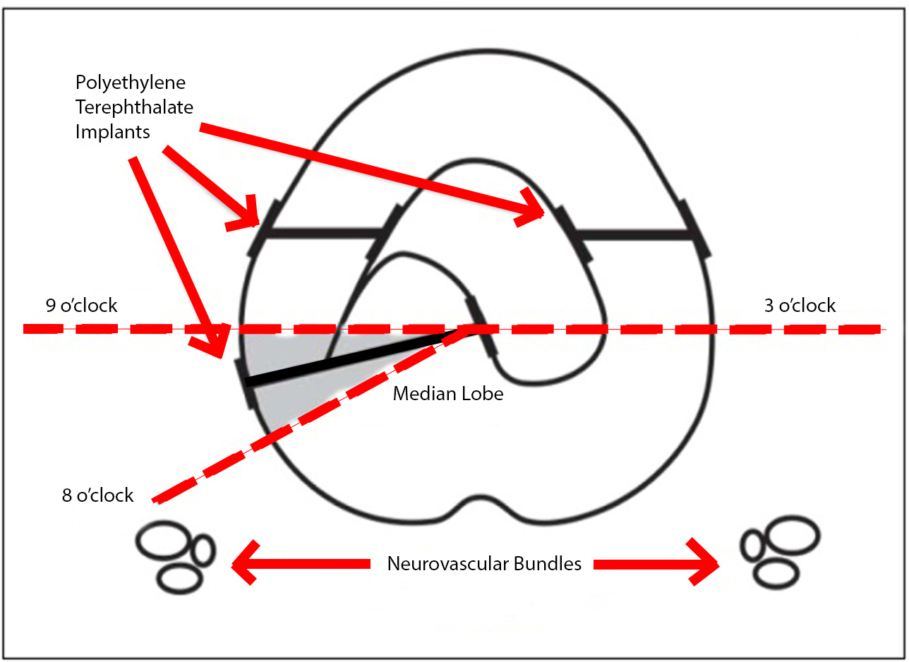 <p>Modified Median Lobe Technique