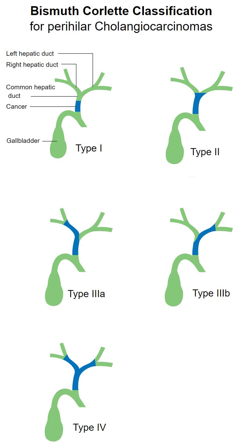 <p>Bismuth Corlette Classification of Perihilar Cholangiocarcinoma</p>