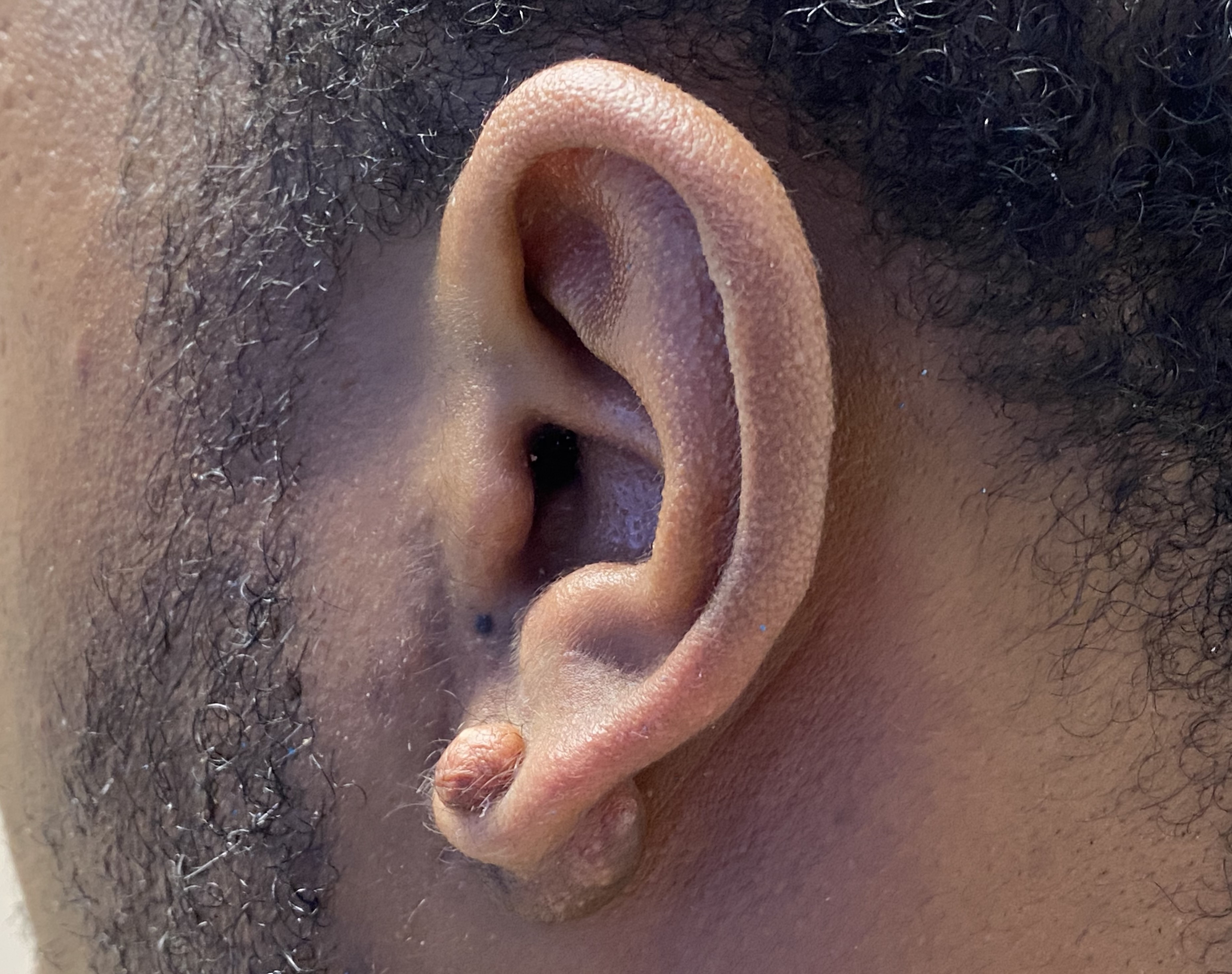 <p>Auricular Lobule Keloid