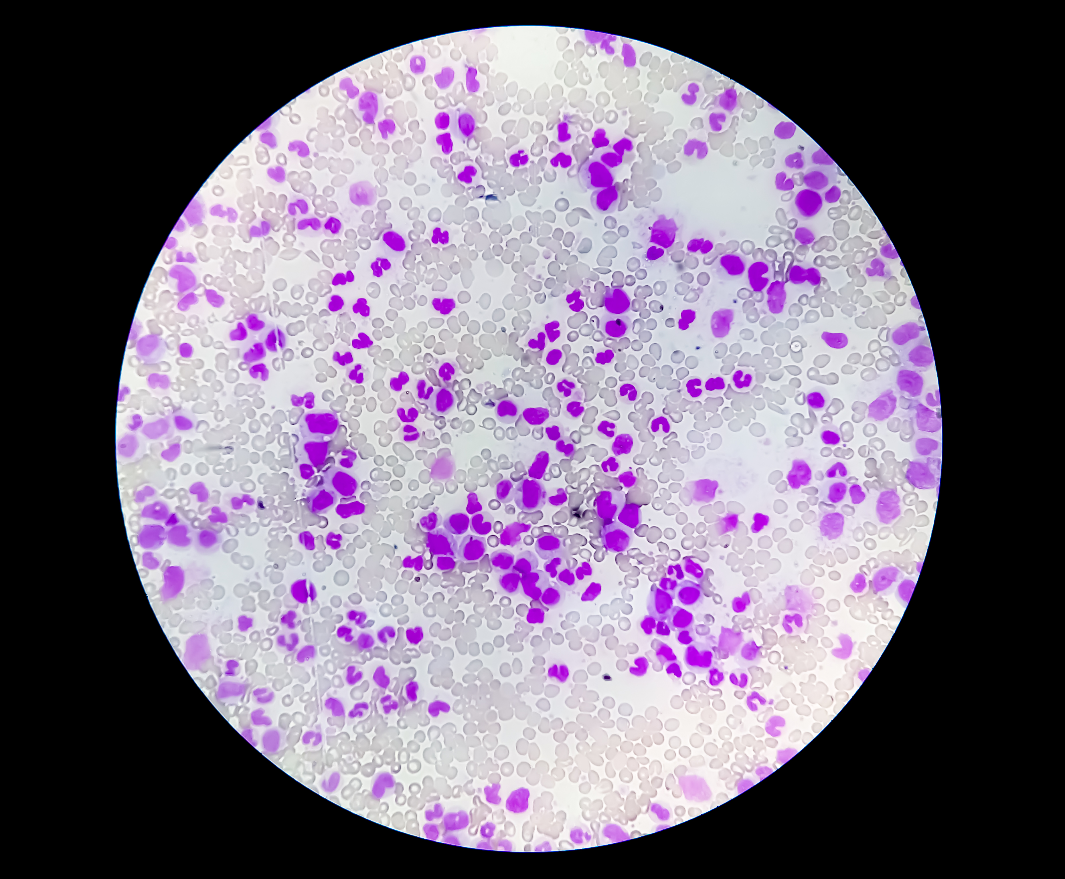 <p>Thrombocytopenia. This image shows normal red and white blood cell counts&nbsp;and a reduced platelet number.</p>