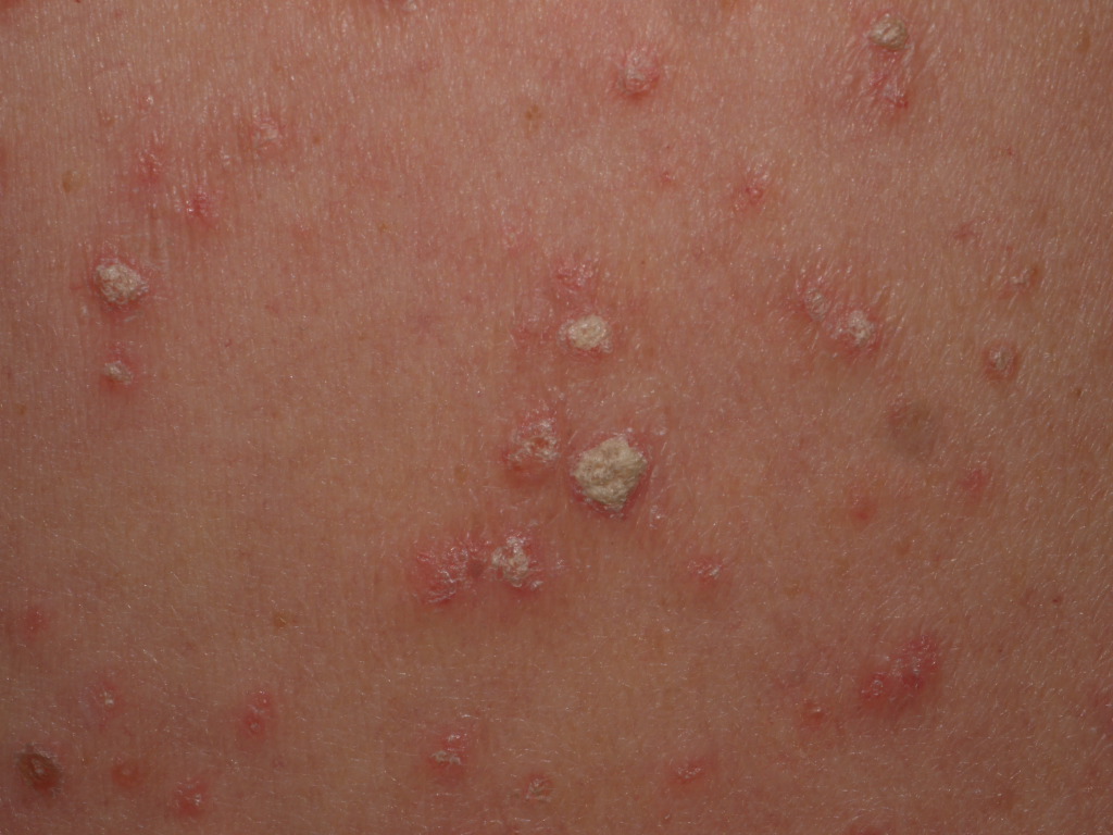 <p>Guttate Psoriasis</p>