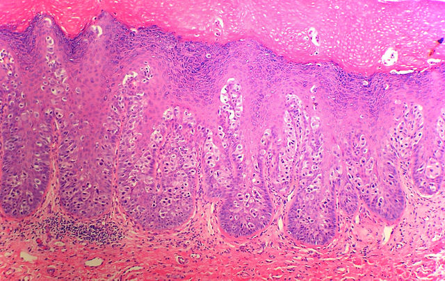 <p>Histology of Extramammary Paget Disease.</p>