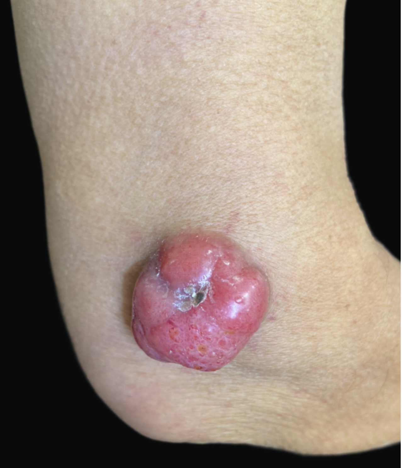 <p>Merkel Cell Carcinoma.&nbsp;</p>