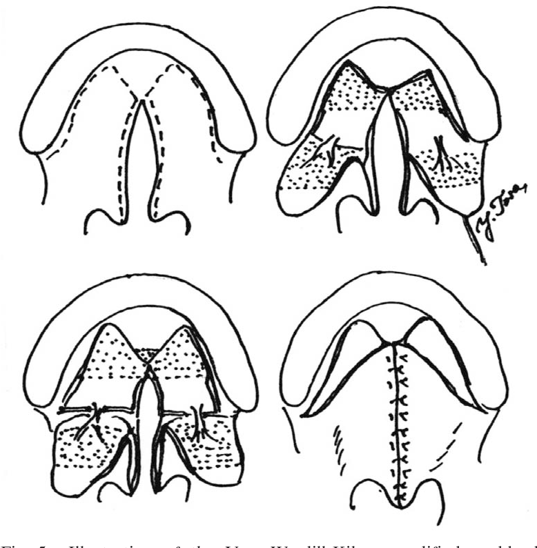 <p>Veau-Wardill-Kilner V to Y pushback palatoplasty</p>