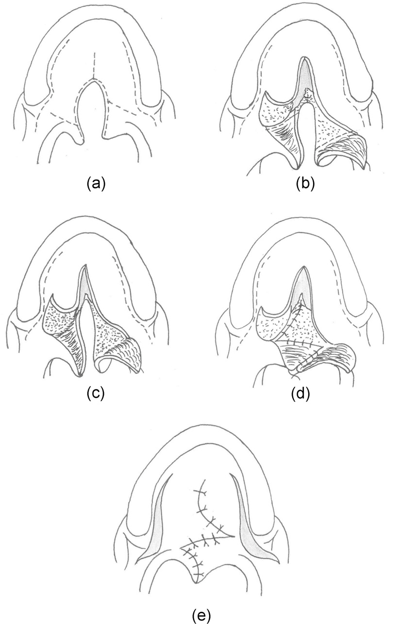 <p>Furlow Palatoplasty</p>