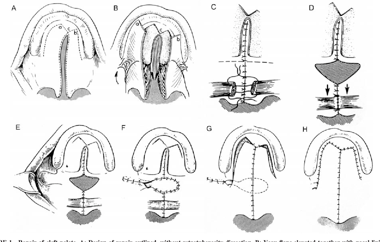 <p>Buccal mucosal flap in primary palatoplasty</p>