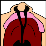 <p>Bilateral Cleft Palate. This illustrated&nbsp;image&nbsp;is&nbsp;a bilateral cleft palate.</p>