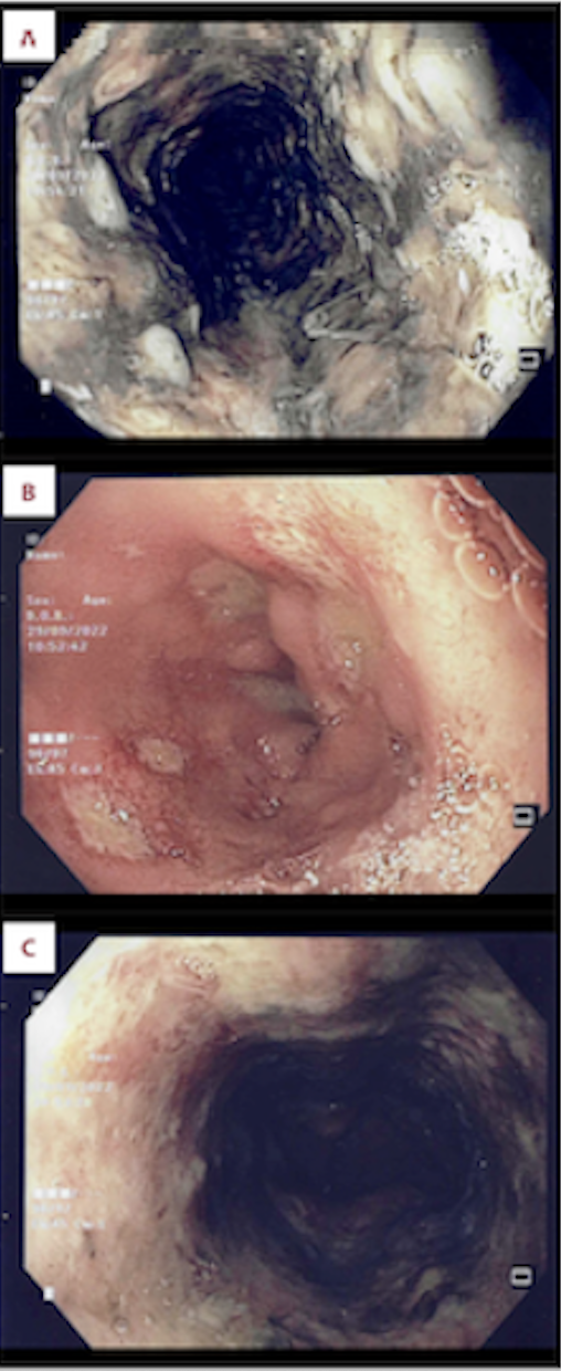 <p>Esophageal Necrosis Endoscopy