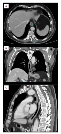 <p>Esophageal Thickening, Chest CT