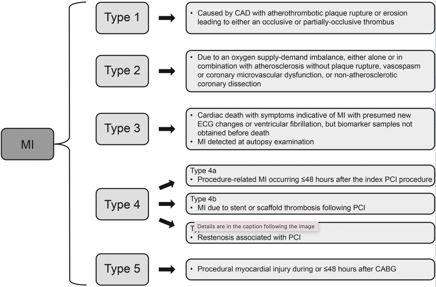 <p>Acute&nbsp;Myocardial Infarction Types