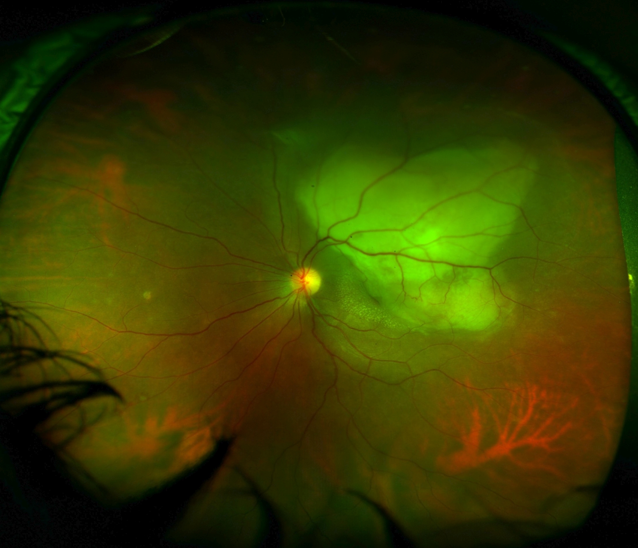 <p>Choroidal Tuberculosis Abscess. Image of a subretinal abscess in choroidal tuberculosis.</p>