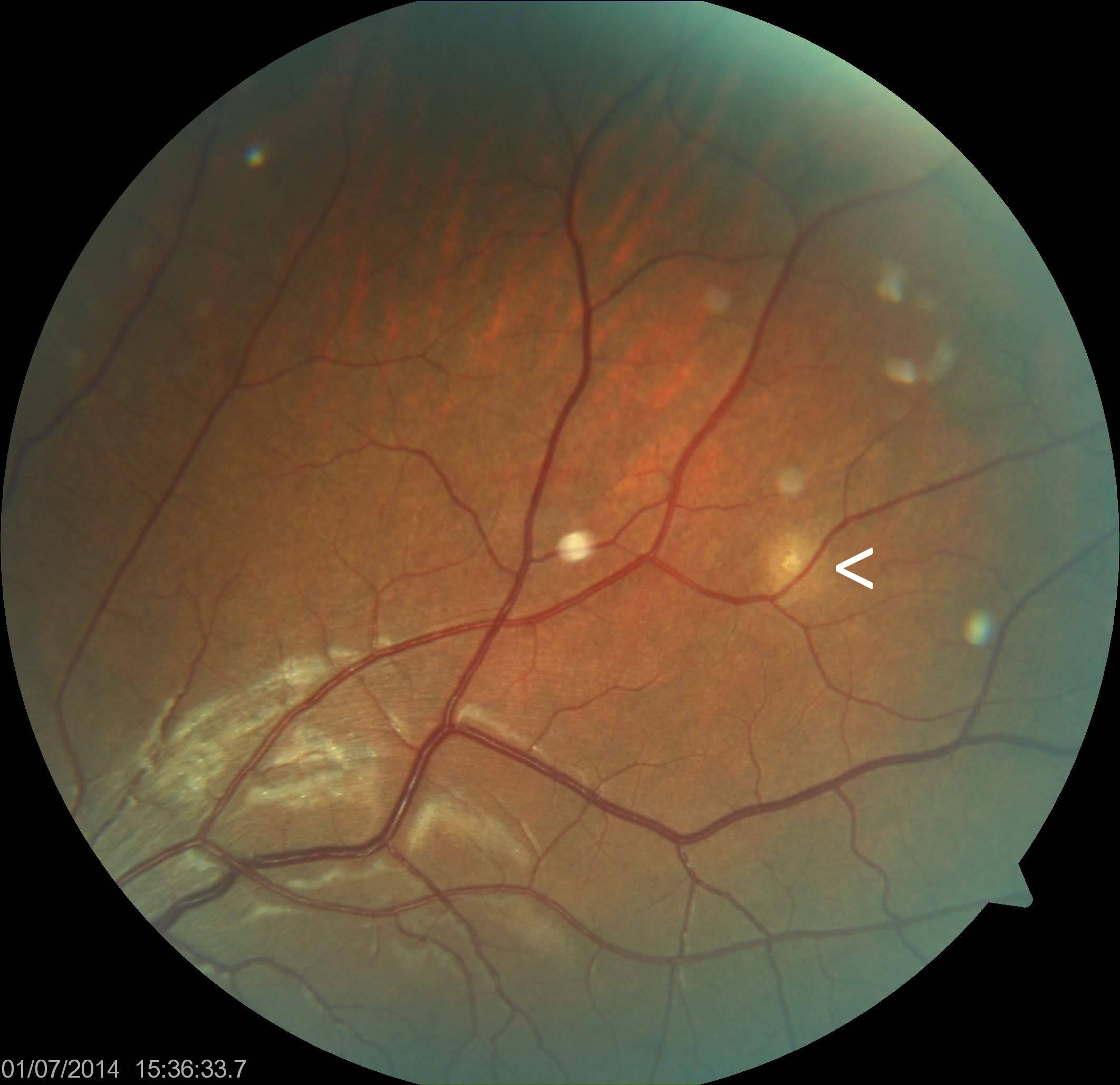 <p>Choroidal Tubercle. Choroidal tubercle (marked with &lt;) in a patient with miliary tuberculosis.</p>