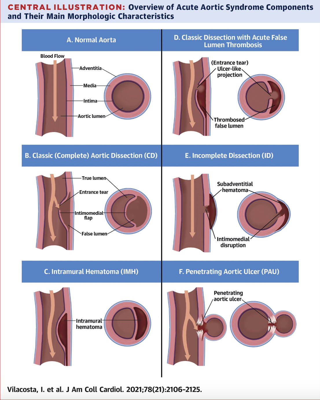 <p>Acute Aortic Syndromes