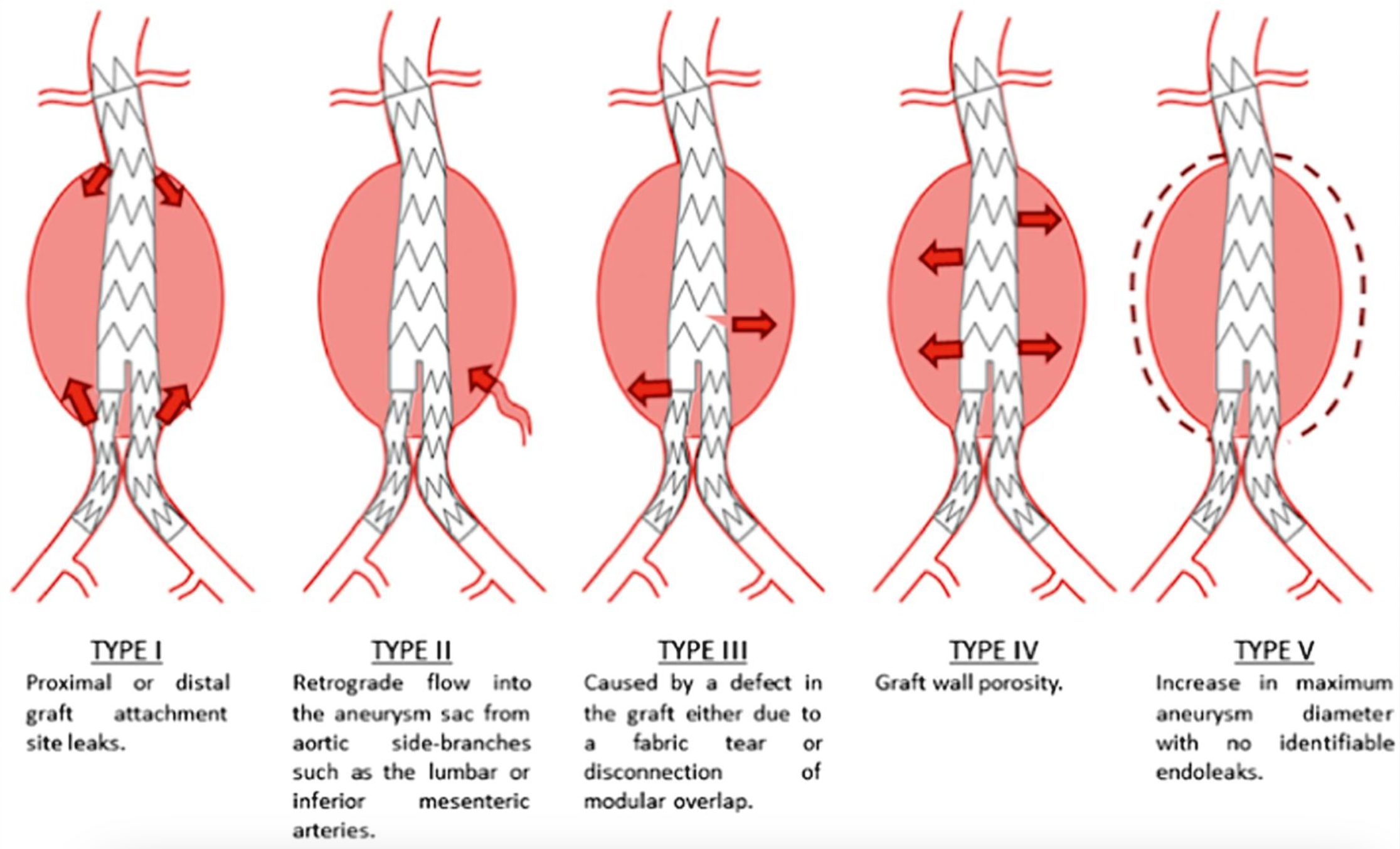 <p>Endoleak Types. This illustration shows the differences between the 5 types of aortic endoleaks.</p>