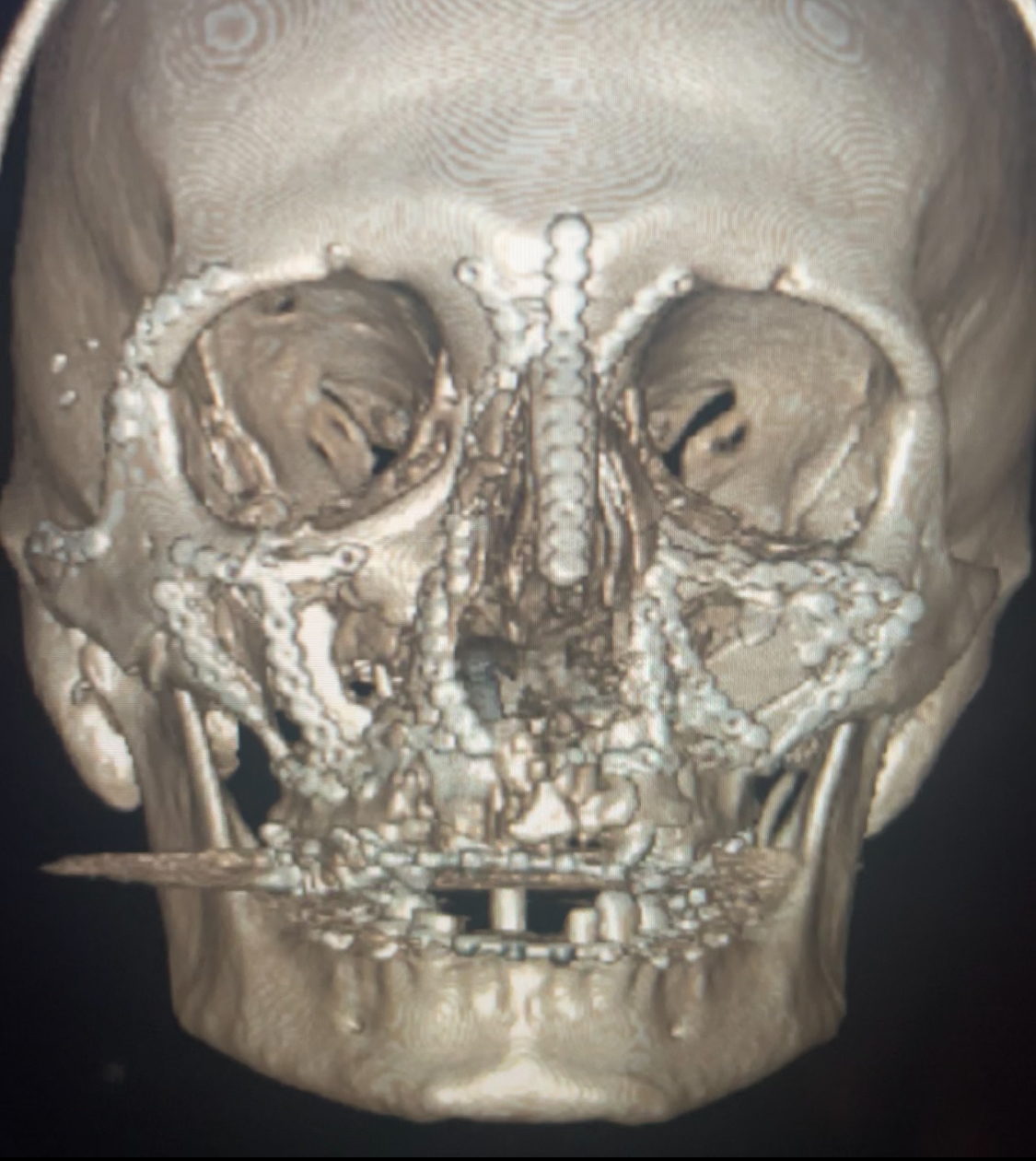 <p>Panafacial Fractures