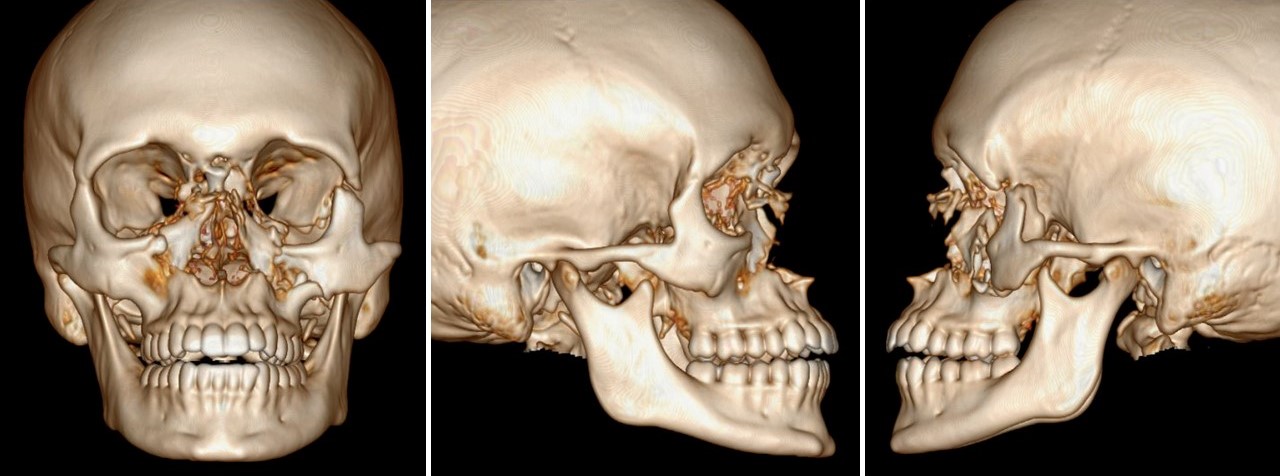 <p>Midfacial Fractures