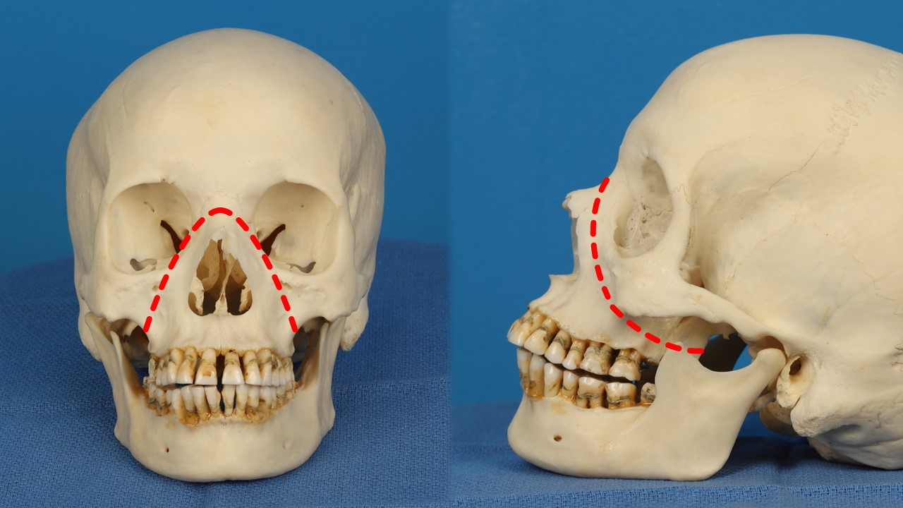 <p>Le Fort II Pyramidal Fracture