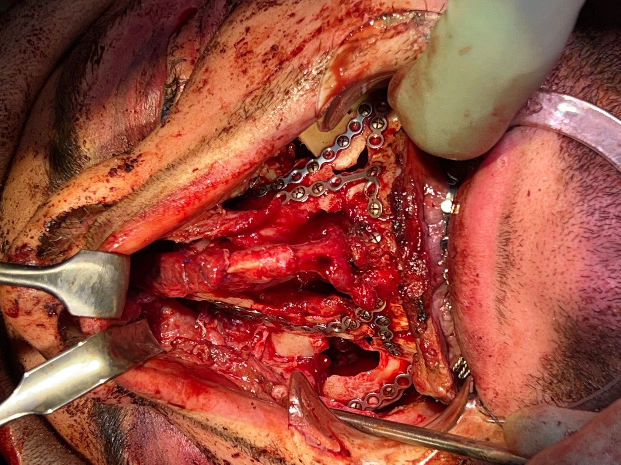 <p>Open Reduction and Internal Fixation of Midface Fractures