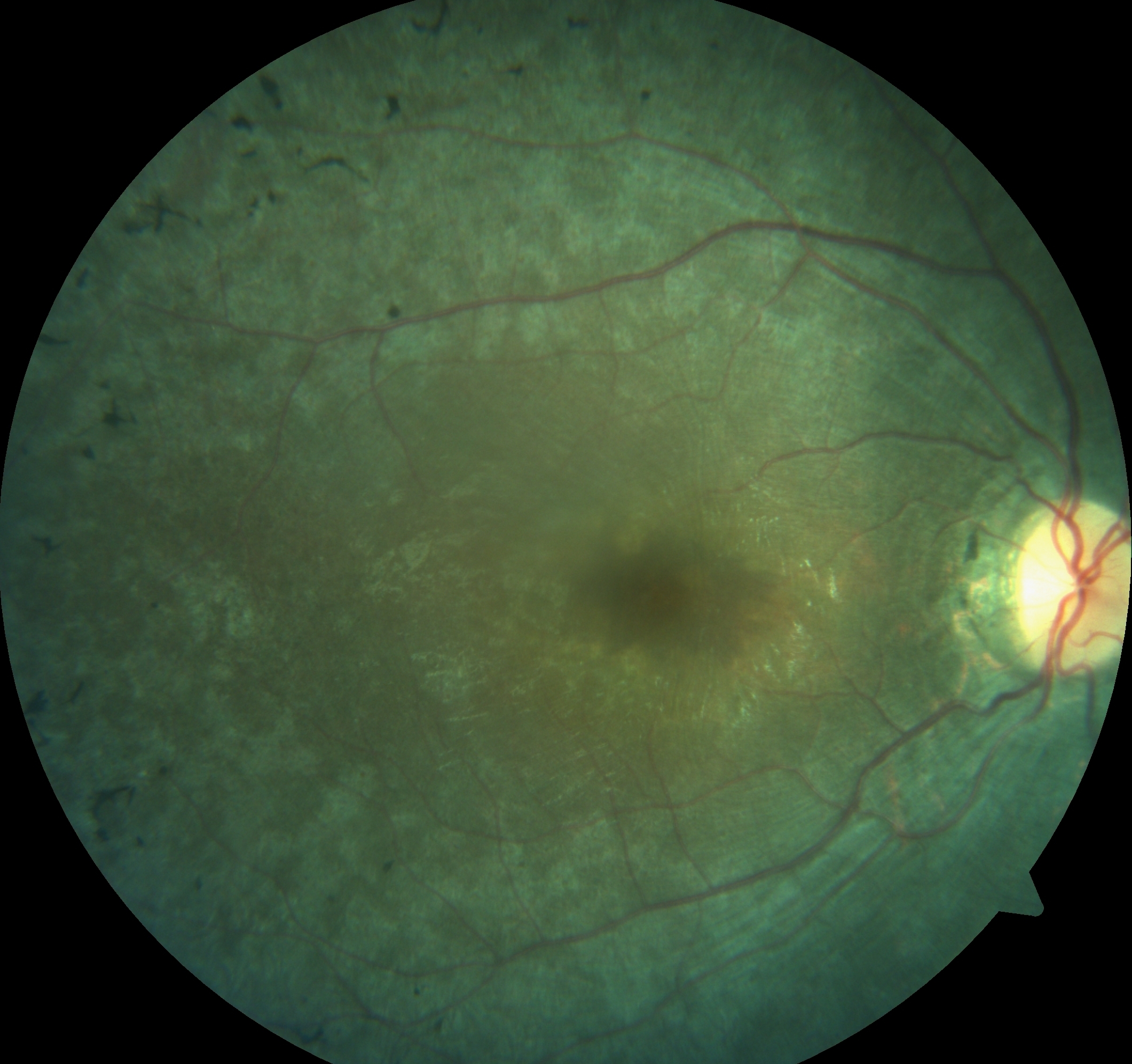 <p>Pigmentary Retinopathy. Pigmentary retinopathy in a patient with Bardet Biedl syndrome.</p>