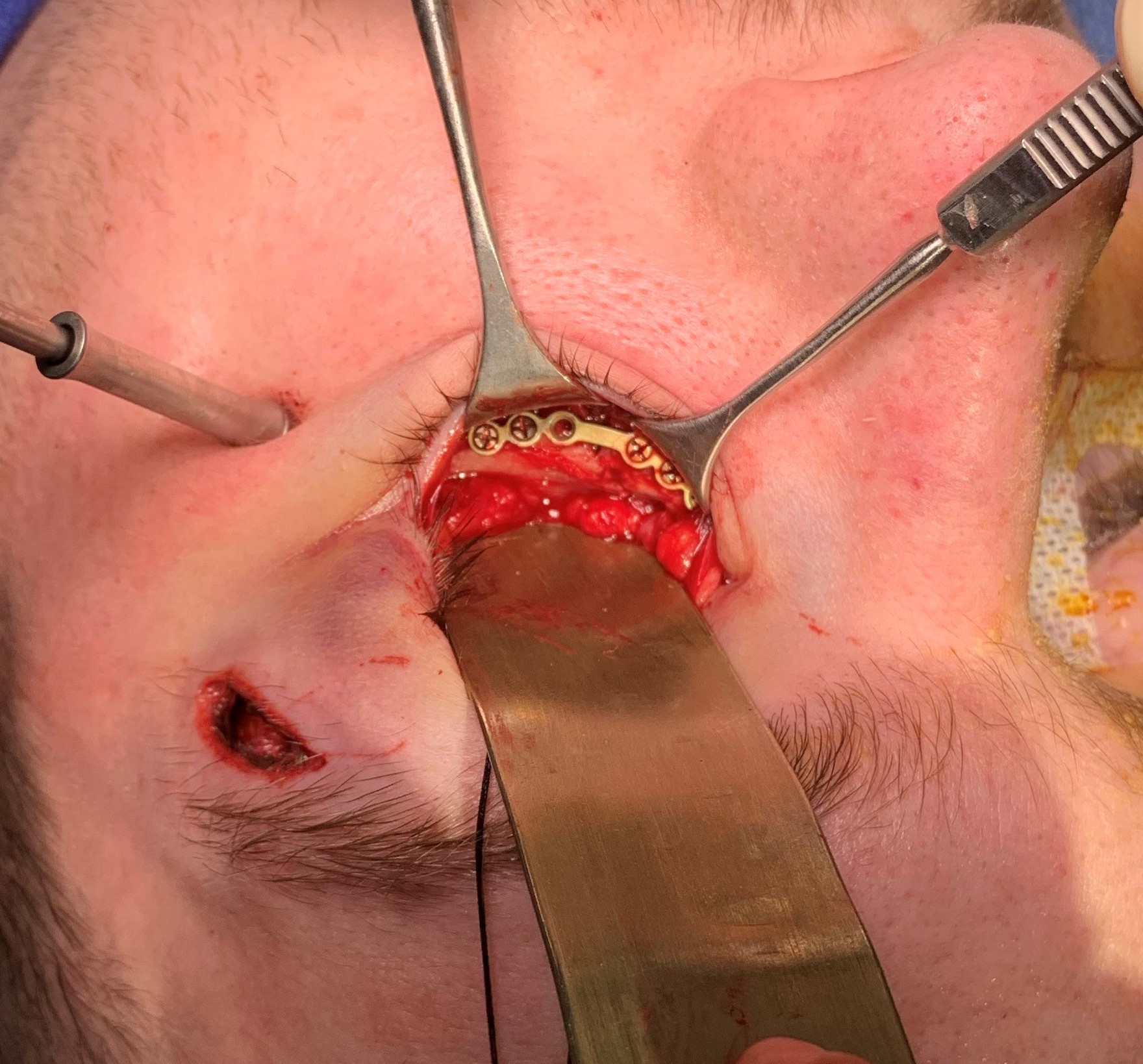 <p>Left Orbital Floor Fracture, Transconjunctival, Post-Septal Approach