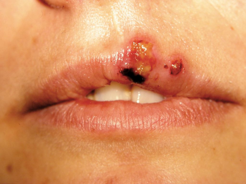 <p>Herpes Simplex</p>