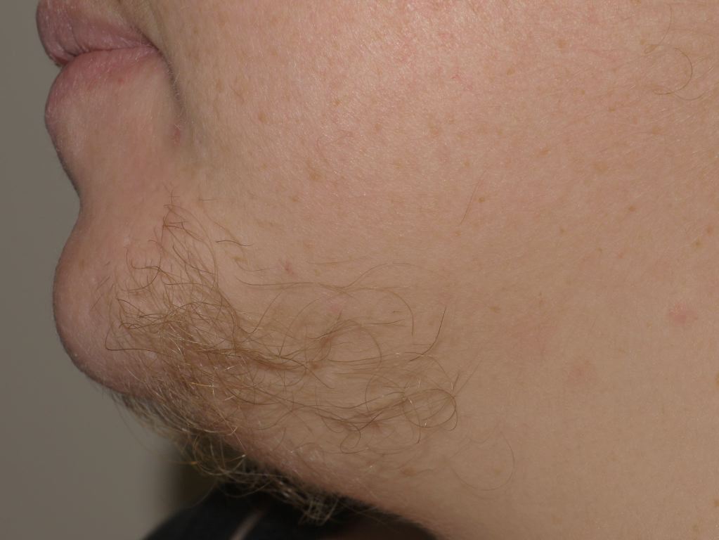 <p>Hirsutism, Chin</p>