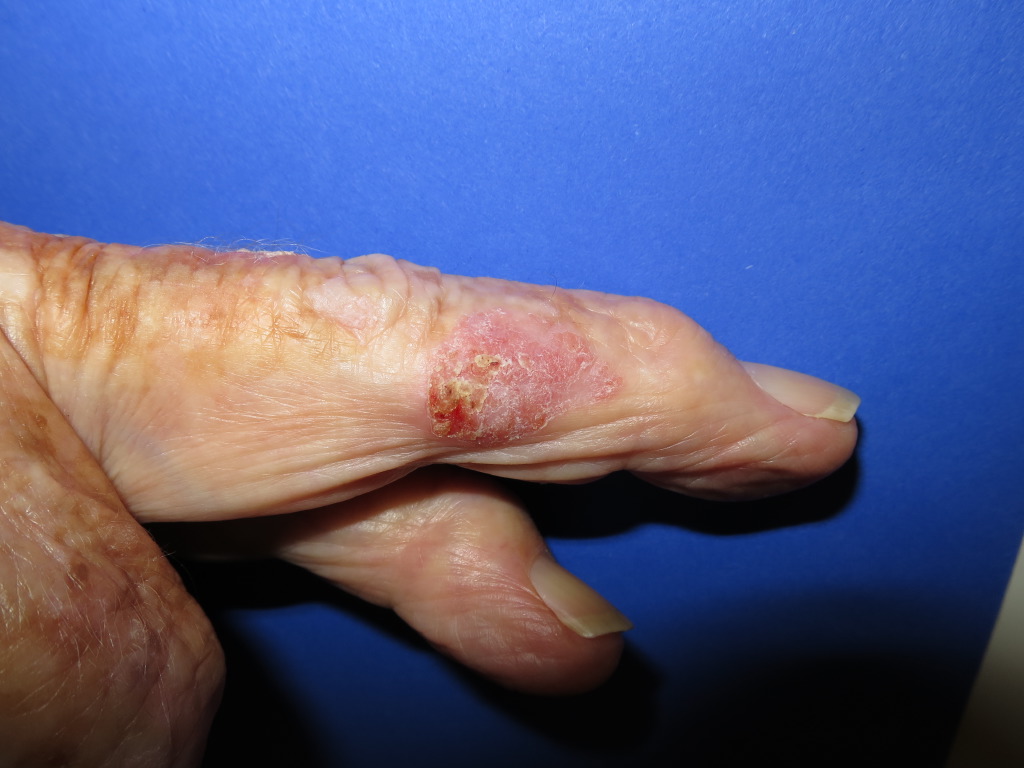 <p>Intraepidermal Carcinoma</p>