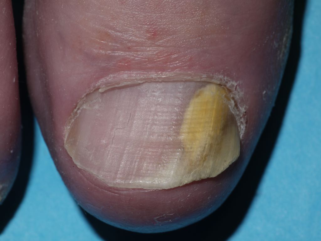 <p>Lateral Onychomycosis</p>