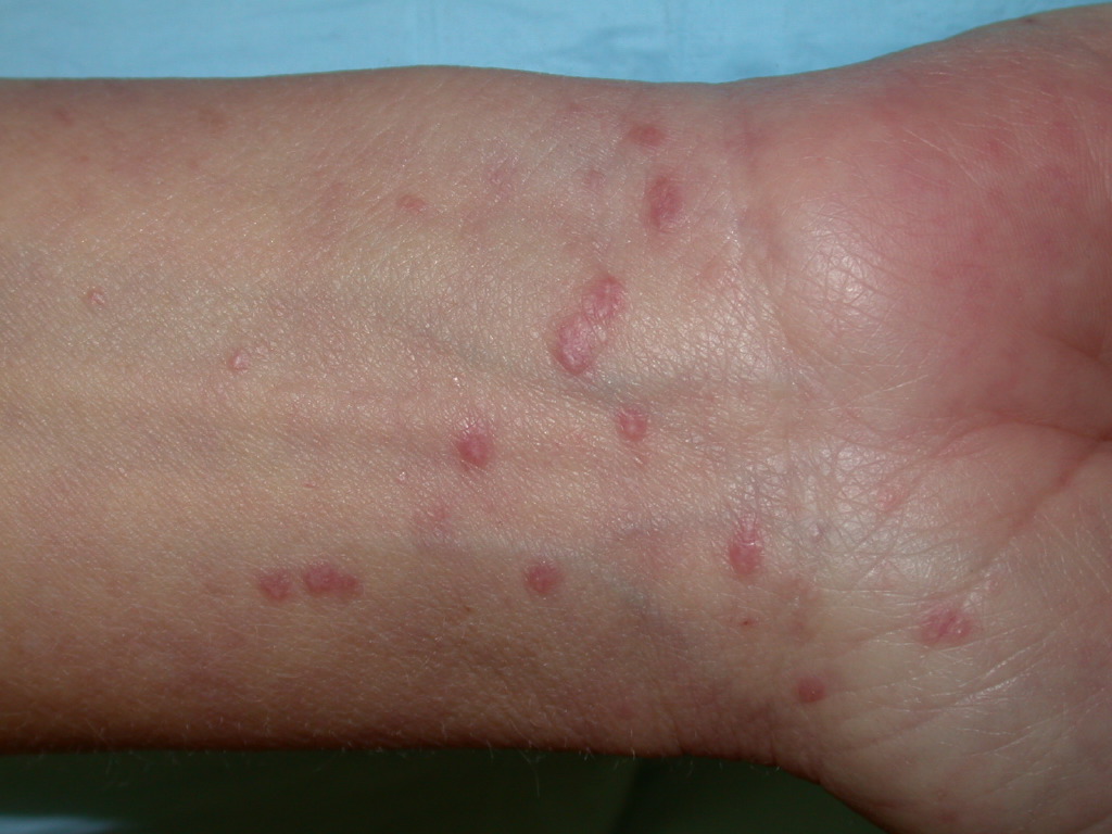 <p>Lichen Planus