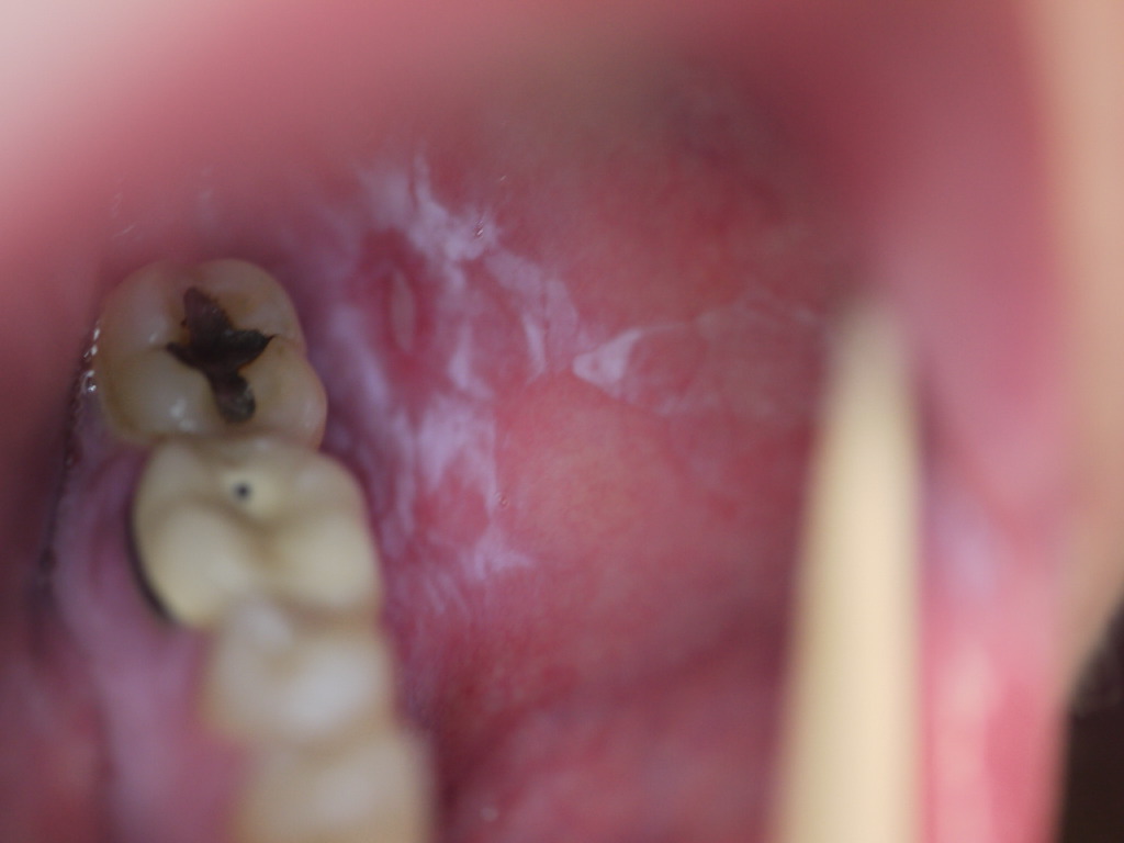 <p>Oral Lichen Planus