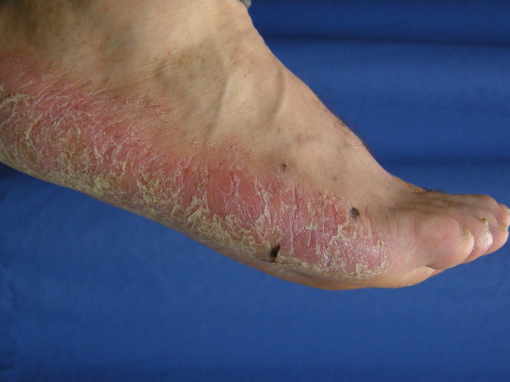 <p>Palmoplantar Psoriasis</p>