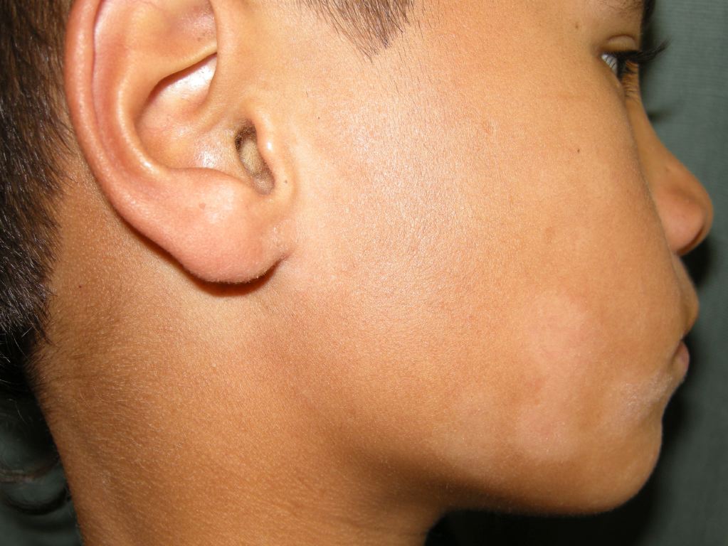 <p>Pityriasis Alba