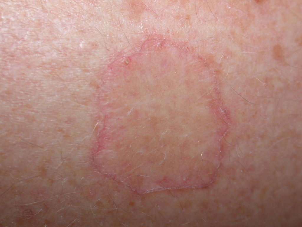 <p>Porokeratosis</p>