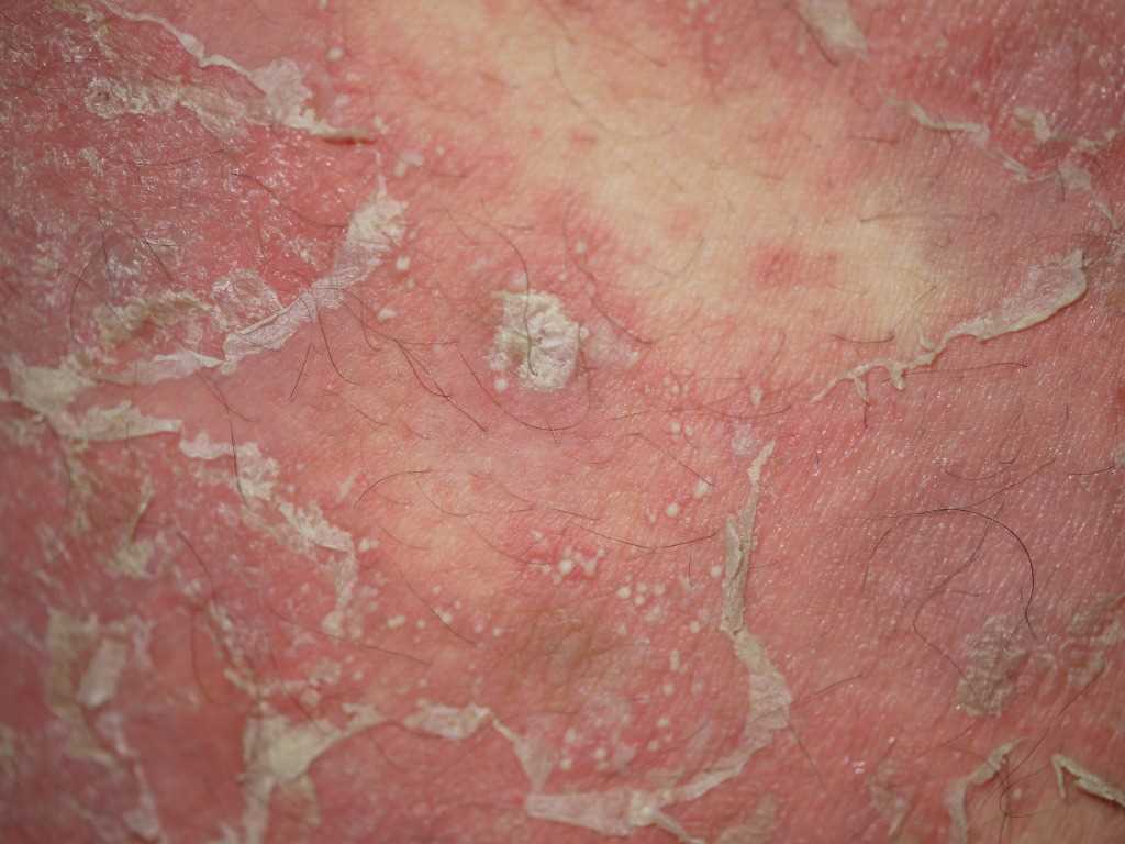 <p>Pustular Psoriasis