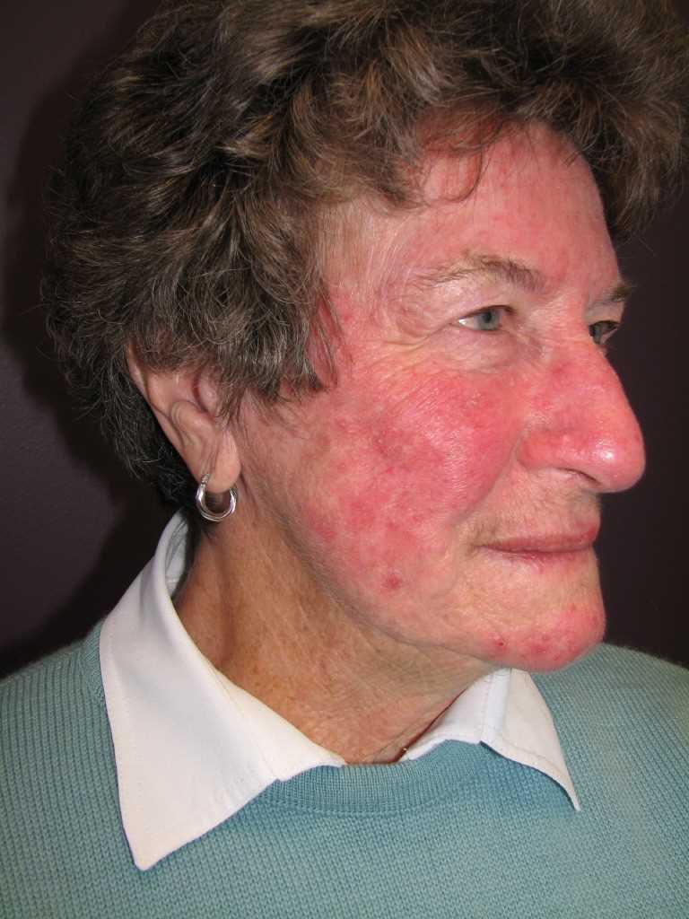 <p>Rosacea, Face</p>