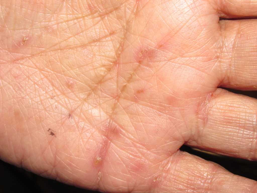 <p>Scabies Burrows</p>